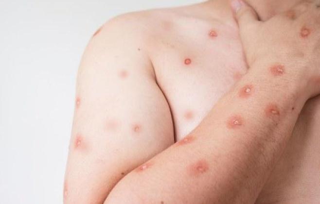 SES alerta para monitoramento de casos de Mpox em MT após avanço de variante em Rondônia