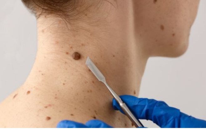 Prefeitura de Cáceres amplia atendimento dermatológico e reforça cuidado com a saúde da pele