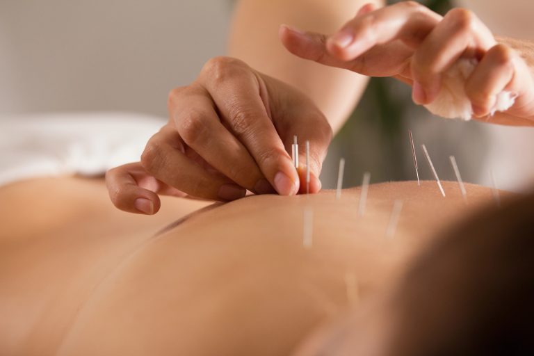 Comissão debate criação do Dia da Acupuntura e da Medicina Tradicional Chinesa